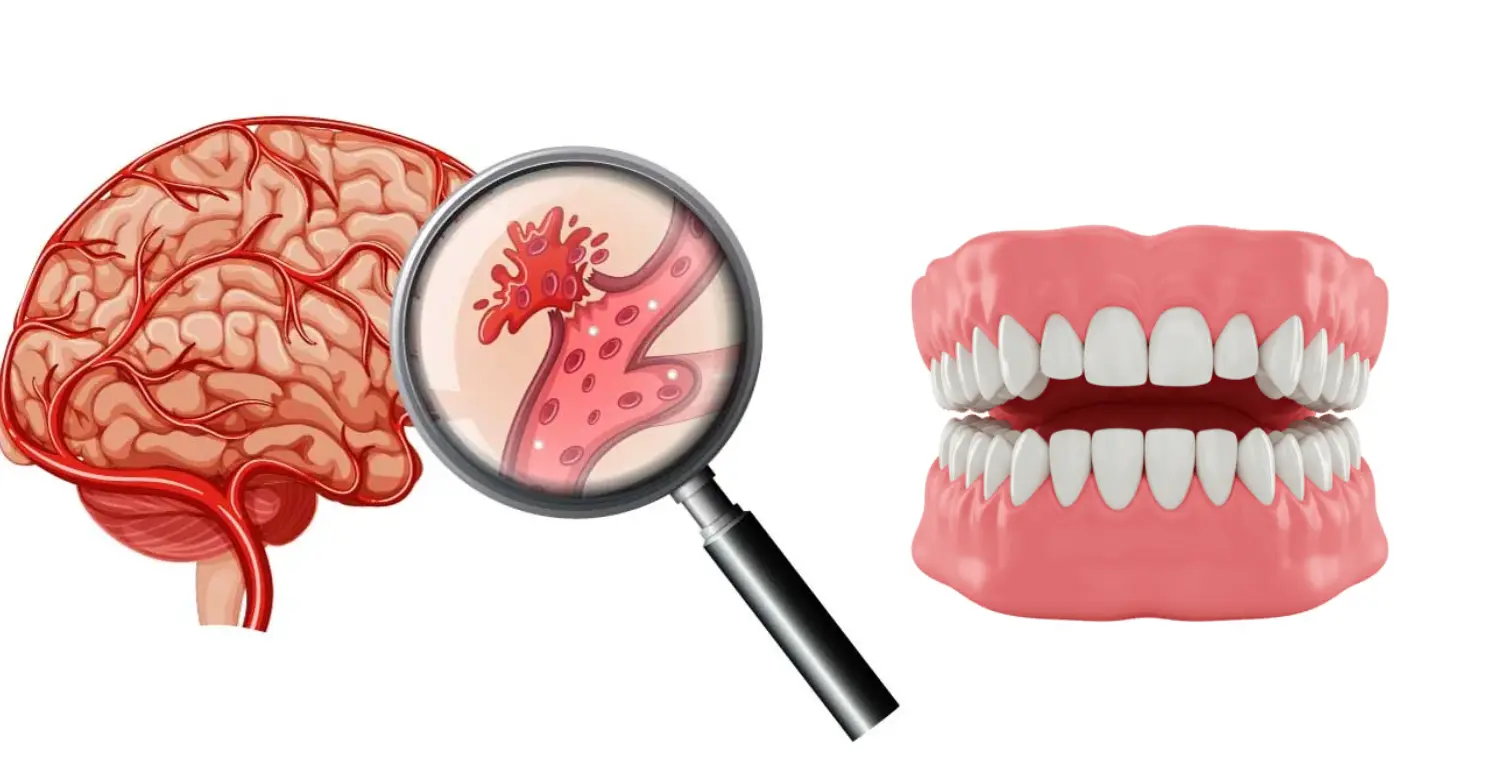 Stroke and Oral Health 2